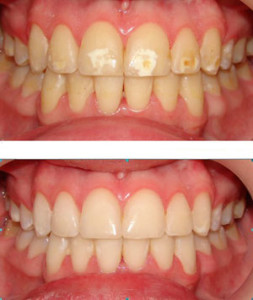 clareador dental whitemax como usar