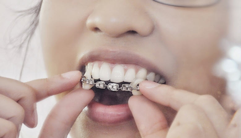 modas dentales _brackets falsos