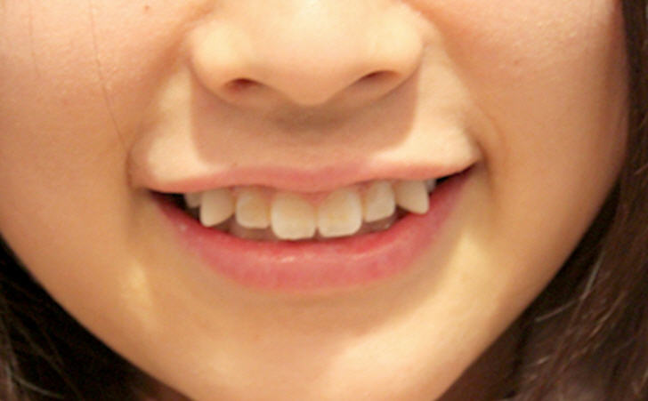 modas dentales _limar caninos